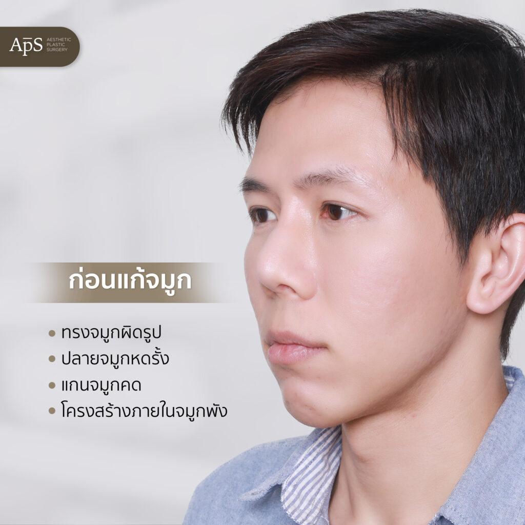 แก้จมูก
