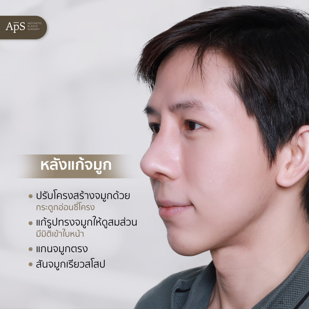 แก้จมูก