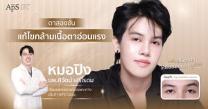 แก้กล้ามเนื้อตาอ่อนแรง