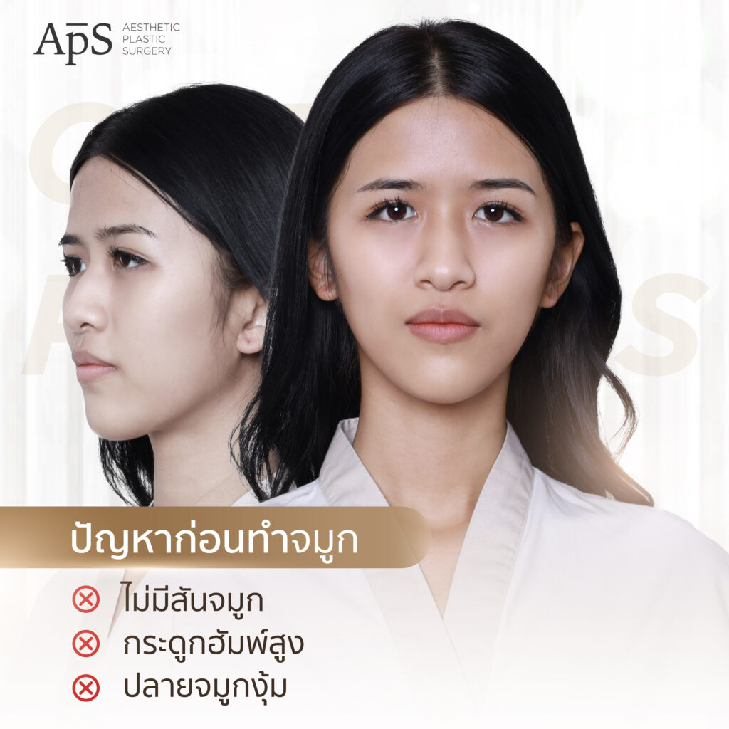 เสริมจมูก Open Rib Plus+