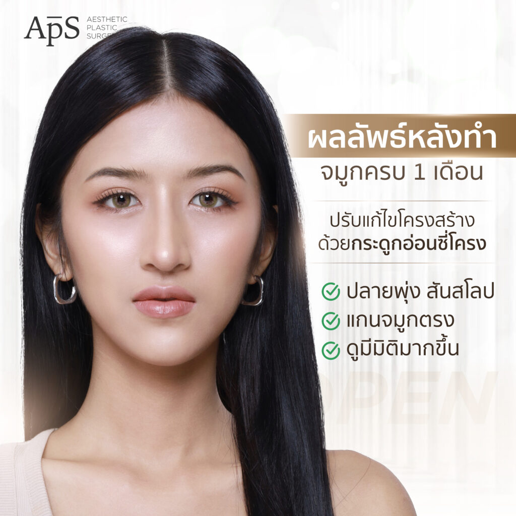 เสริมจมูก Open Rib Plus+ เนื้อจมูกน้อย มีฮัมพ์จมูกสูง ปลายจมูกบางแก้ได้ 3 เสริมจมูก Open Rib Plus+