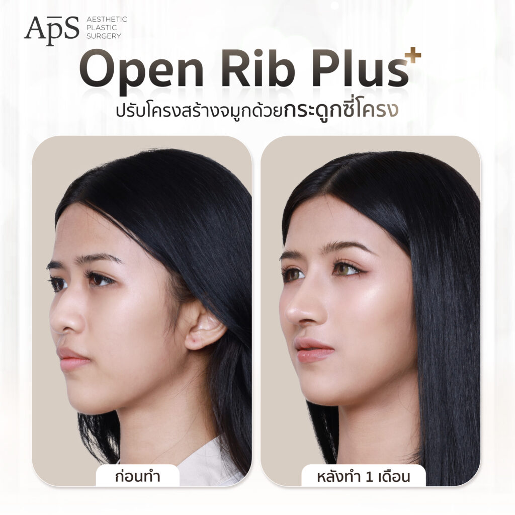 เสริมจมูก Open Rib Plus+