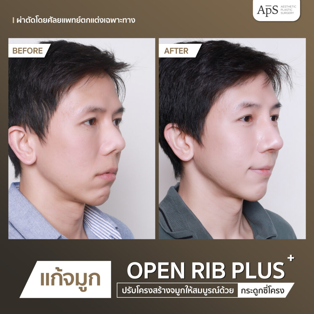 BA open rib plus+
