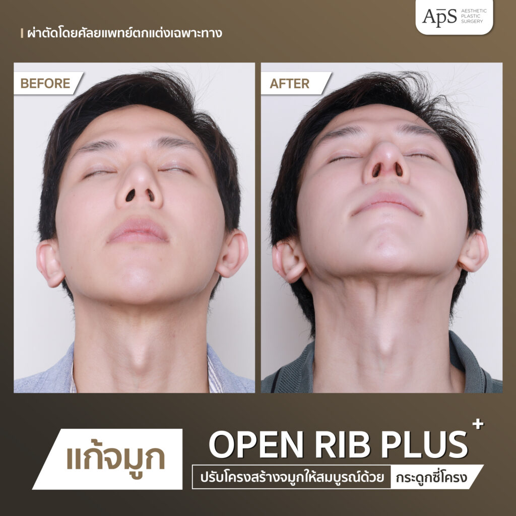 BA open rib plus+