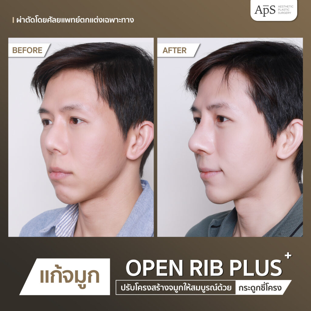 BA open rib plus+