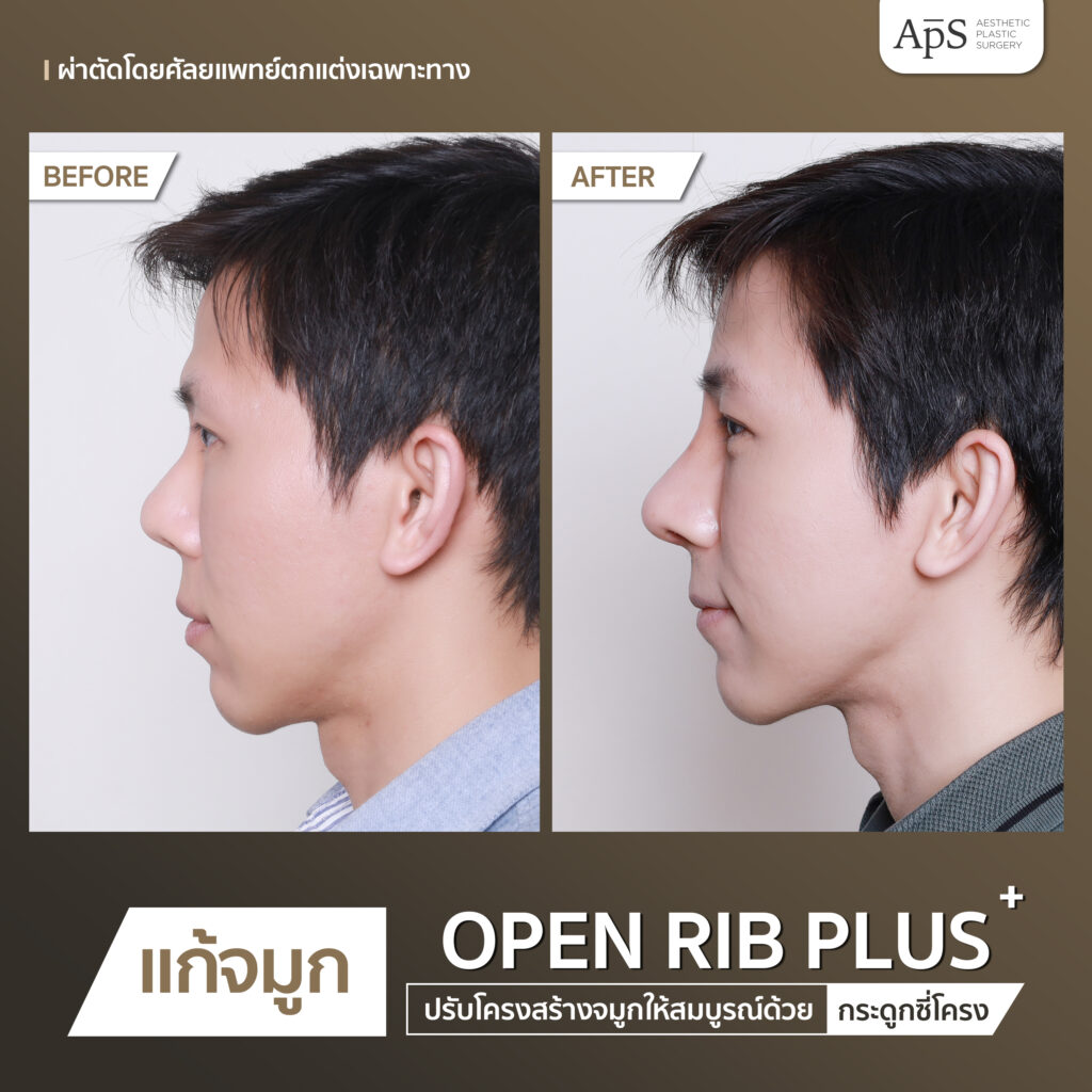 แก้จมูก