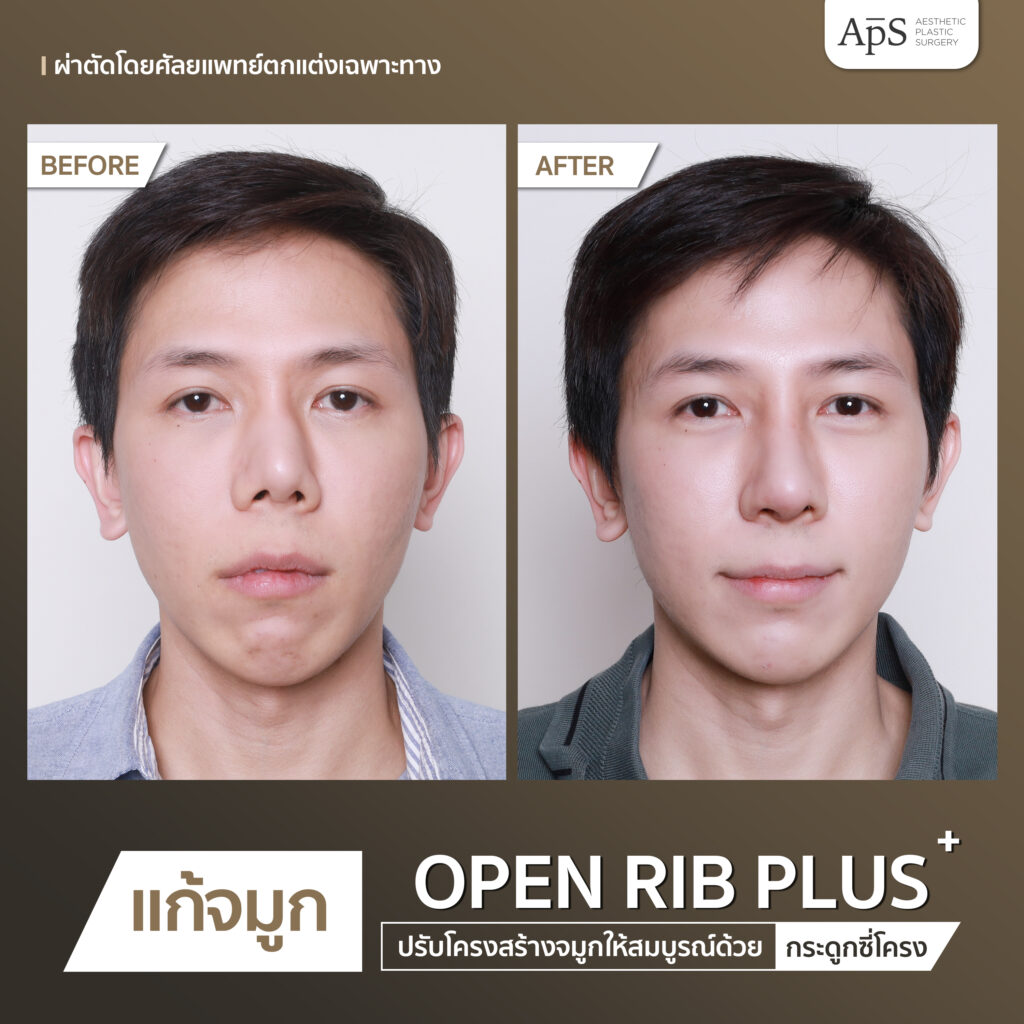 แก้จมูก