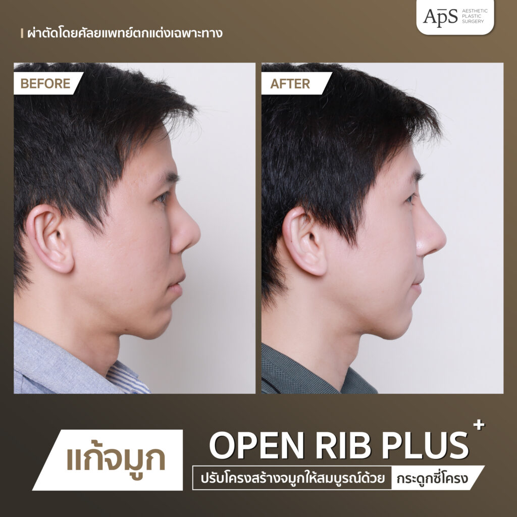 แก้จมูก