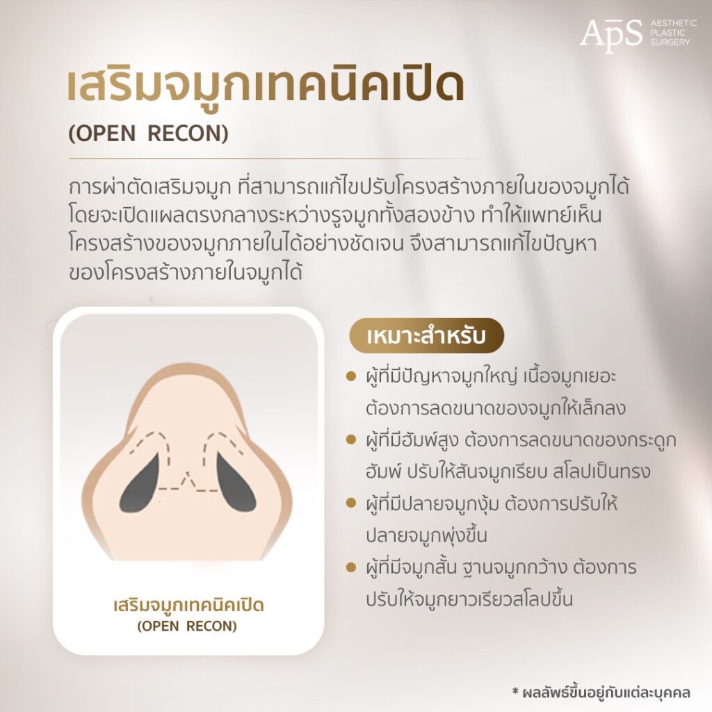 รวม 5 เทคนิคการเสริมจมูกที่ APS Clinic 5 เสริมจมูก
