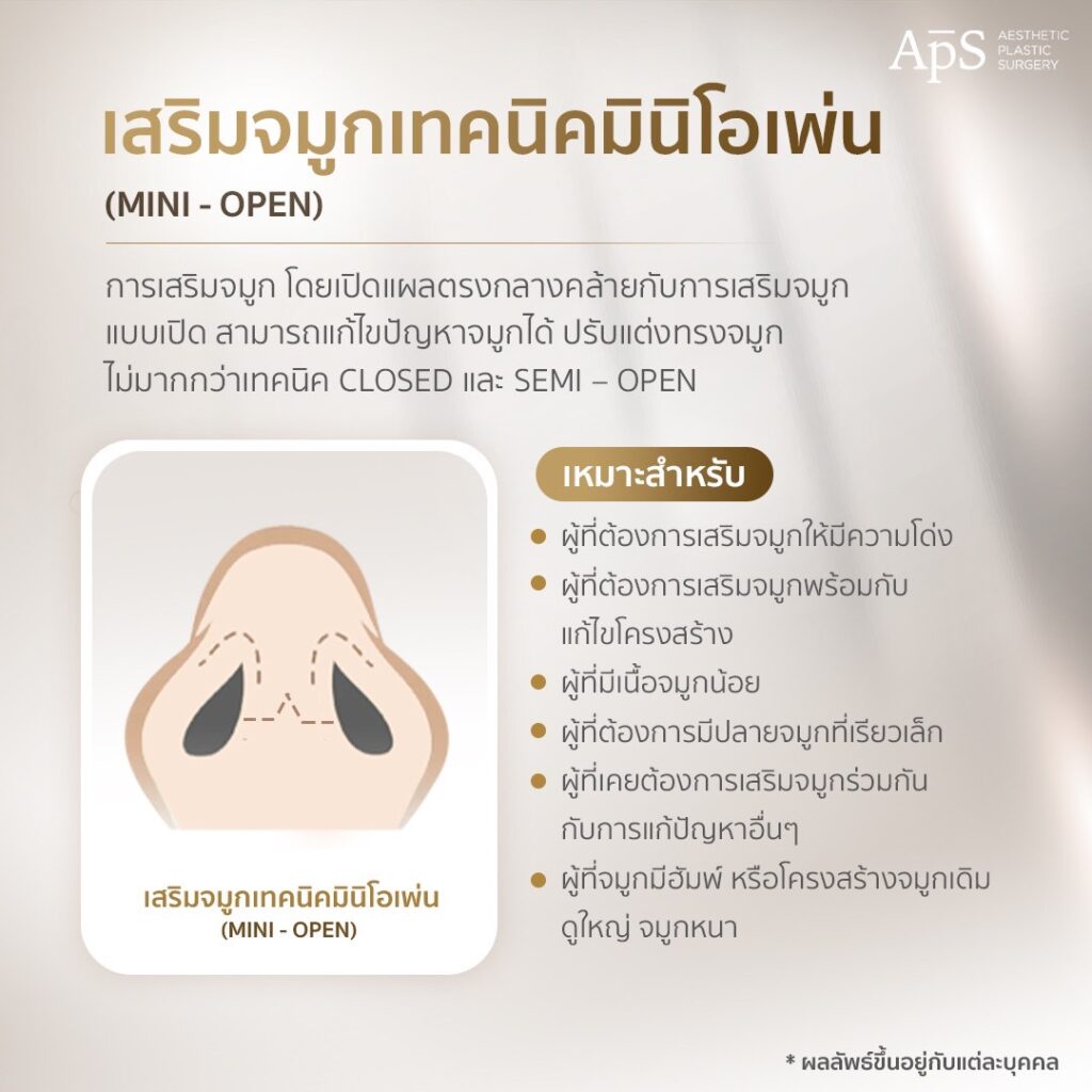 รวม 5 เทคนิคการเสริมจมูกที่ APS Clinic 4 เสริมจมูก