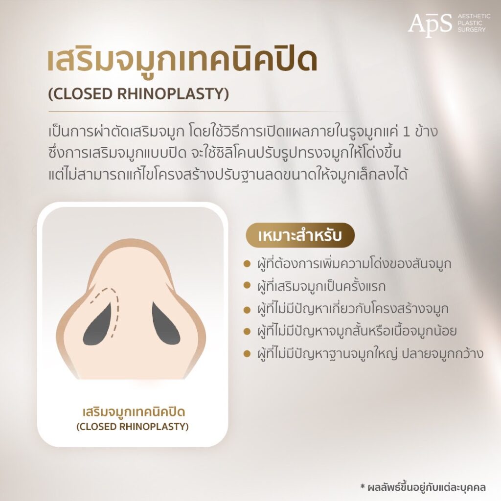 รวม 5 เทคนิคการเสริมจมูกที่ APS Clinic 2 เสริมจมูก