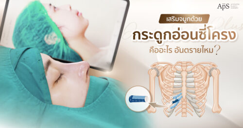 เสริมจมูกด้วยกระดูกอ่อนซี่โครงคืออะไร