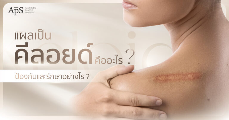 คีลอยด์คืออะไร