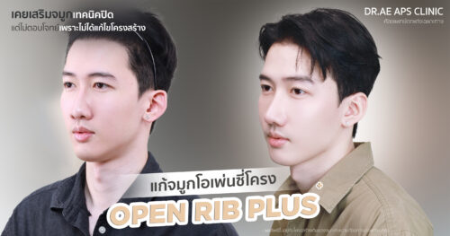 แก้จมูกด้วยเทคนิค Open Rib Plus+