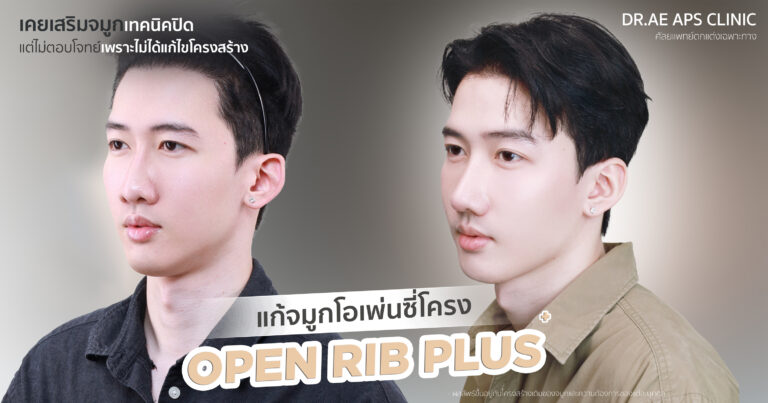 ทำจมูกแล้วไม่ได้ดั่งใจ จนต้องแก้จมูก 3 แก้จมูกด้วยเทคนิค Open Rib Plus+