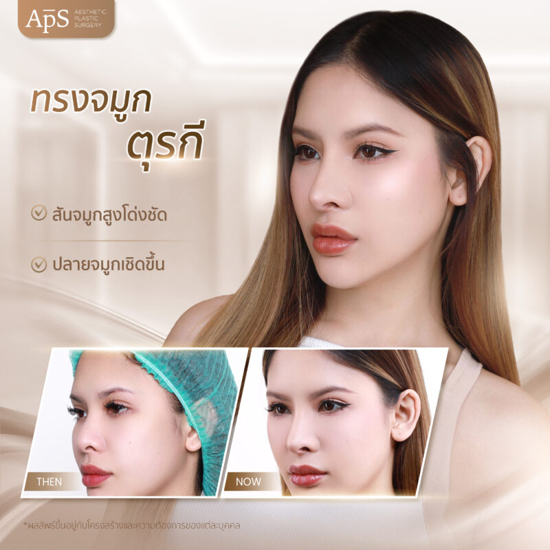 ทรงจมูกยอดนิยมปี 2025 เพิ่มความมั่นใจทุกมุมมอง 5 ทรงจมูกตุรกี