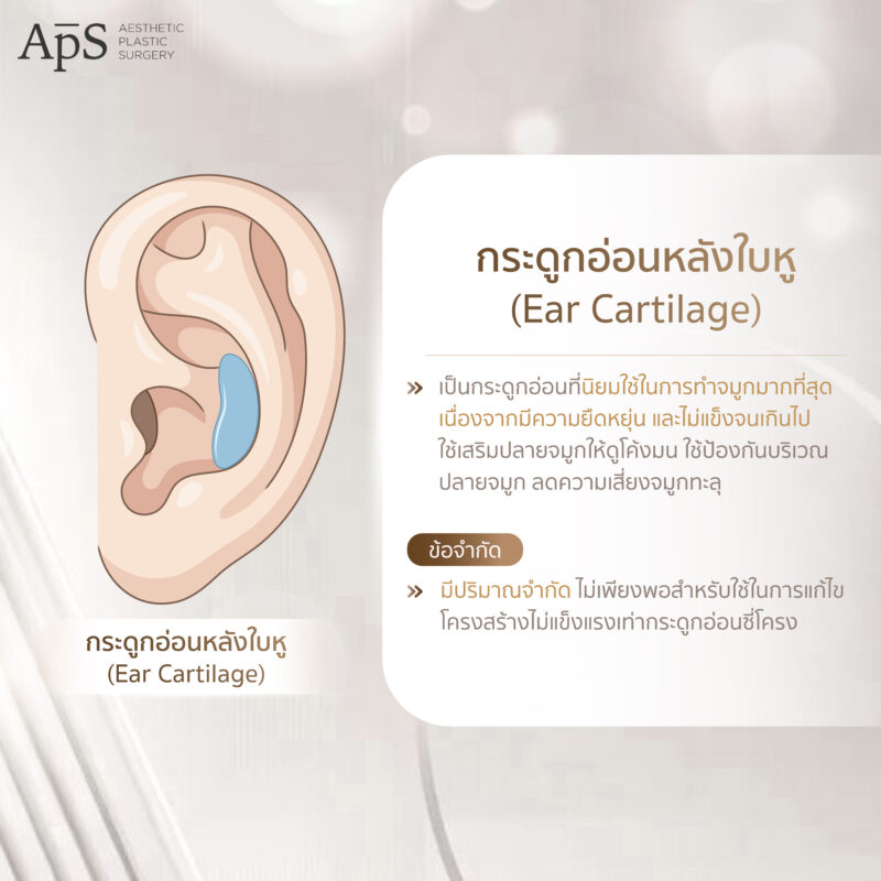การเสริมจมูกด้วยกระดูกอ่อน 3 ชนิดที่ได้จากร่างกาย ปลอดภัย ไม่แพ้ 3 กระดูกอ่อนหลังใบหู (Ear Cartiage)