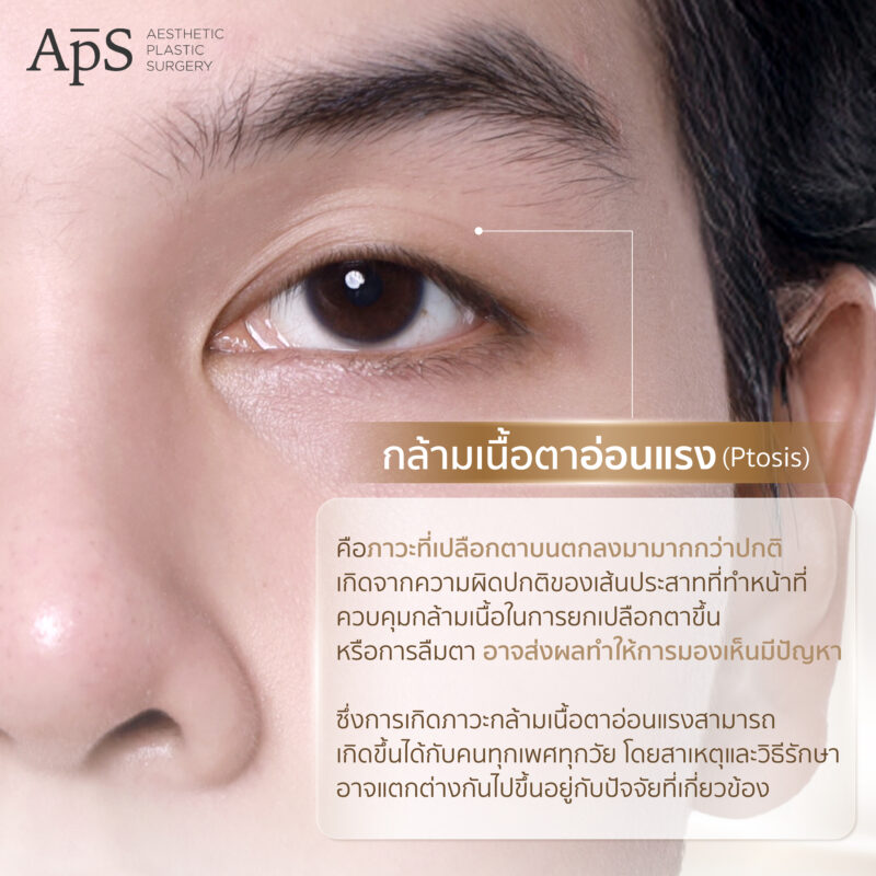 กล้ามเนื้อตาอ่อนแรงคืออะไร (Ptosis) สาเหตุเกิดจากอะไร อันตรายไหม มีวิธีการรักษาแบบไหนบ้าง 2 กล้ามเนื้อตาอ่อนแรง