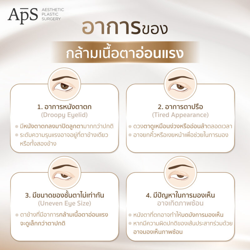 กล้ามเนื้อตาอ่อนแรงคืออะไร (Ptosis) สาเหตุเกิดจากอะไร อันตรายไหม มีวิธีการรักษาแบบไหนบ้าง 5 อาการของกล้ามเนื้อตาอ่อนแรง