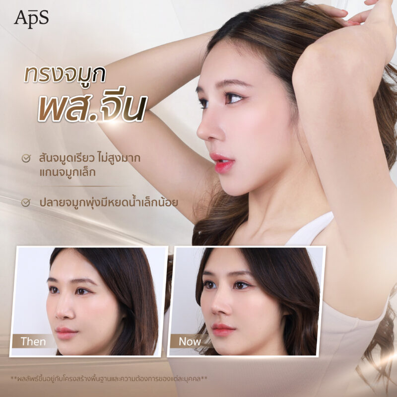 ทรงจมูกยอดนิยมปี 2025 เพิ่มความมั่นใจทุกมุมมอง 4 ทรงจมูกพส.จีน