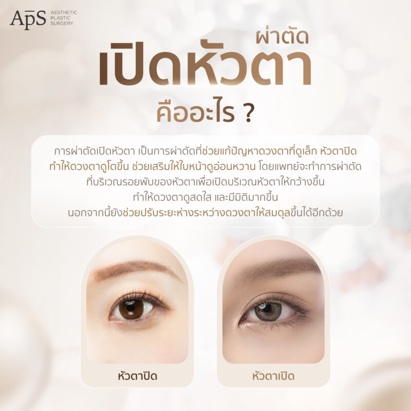 ผ่าตัดศัลยกรรมเปิดหัวตาคืออะไร