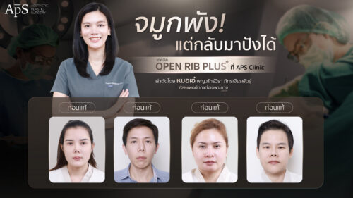 แก้จมูกโอเพ่นซี่โครงเทคนิค Open Rib Plus+