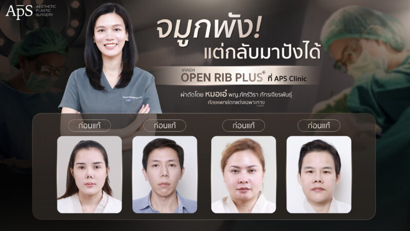 แก้จมูกโอเพ่นซี่โครงเทคนิค Open Rib Plus+