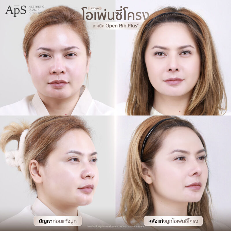 แก้จมูกแบบไหนดีที่สุด เหมาะสมกับใบหน้าของเรามากที่สุด