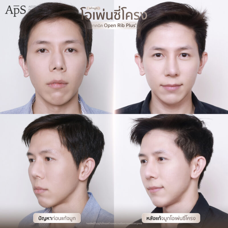 แก้จมูกแบบไหนดีที่สุด เหมาะสมกับใบหน้าของเรามากที่สุด