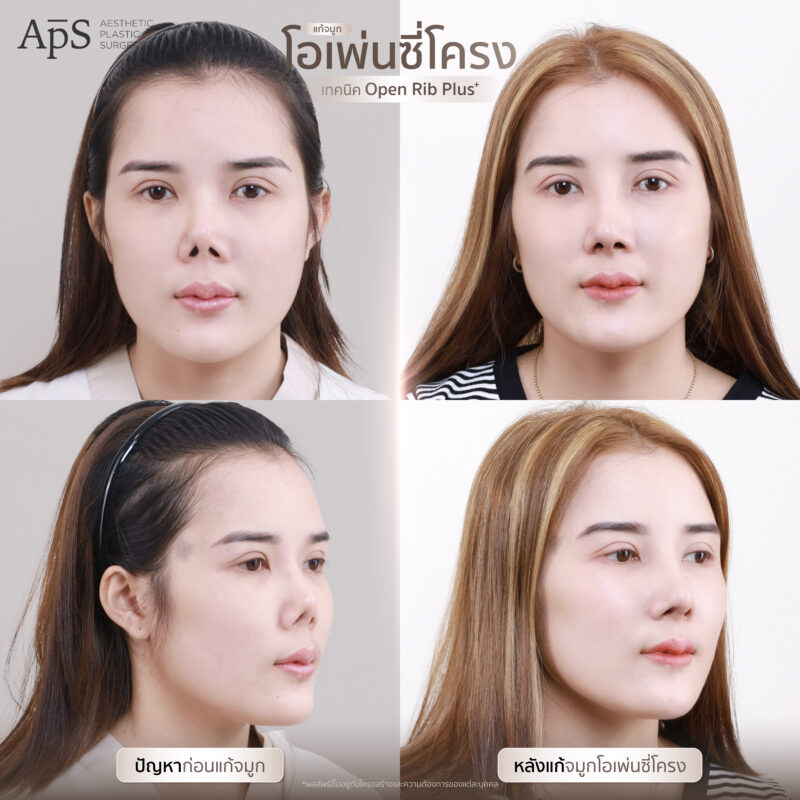 แก้จมูกแบบไหนดีที่สุด เหมาะสมกับใบหน้าของเรามากที่สุด