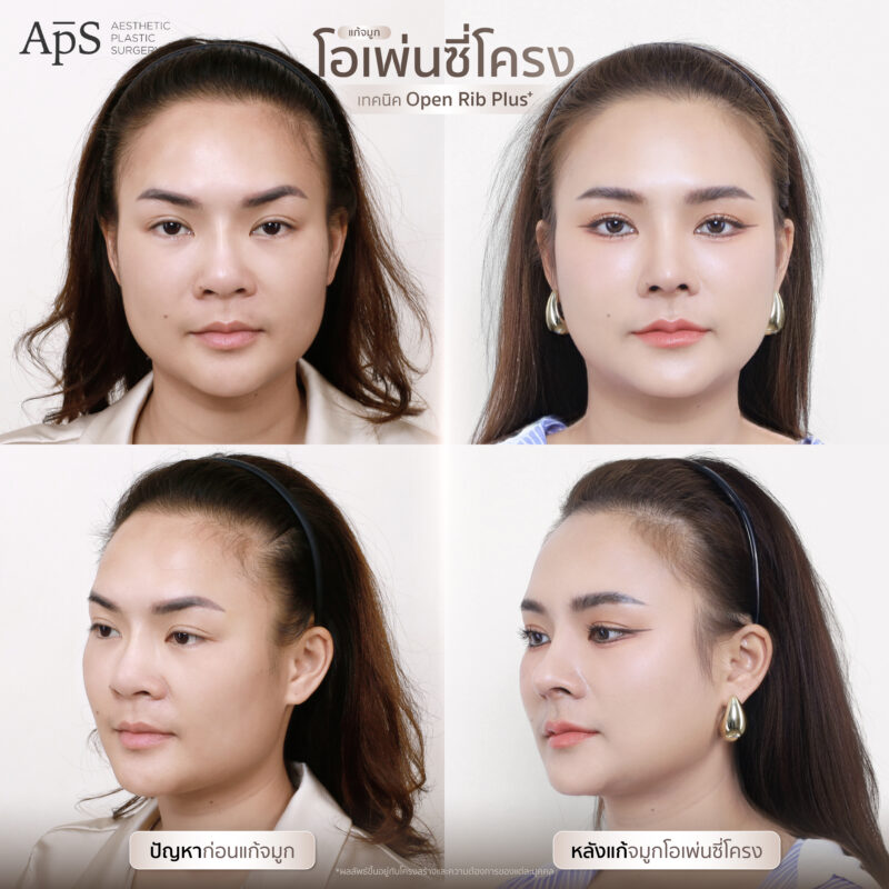แก้จมูกแบบไหนดีที่สุด เหมาะสมกับใบหน้าของเรามากที่สุด