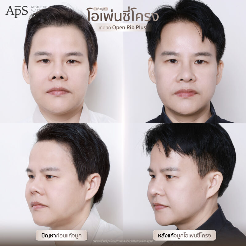 แก้จมูกแบบไหนดีที่สุด เหมาะสมกับใบหน้าของเรามากที่สุด