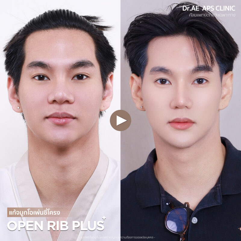 คุณโอม แก้จมูกเพิ่มความมั่นใจ