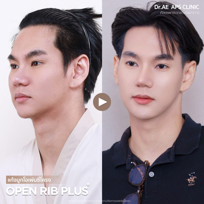 คุณโอม แก้จมูกเพิ่มความมั่นใจ