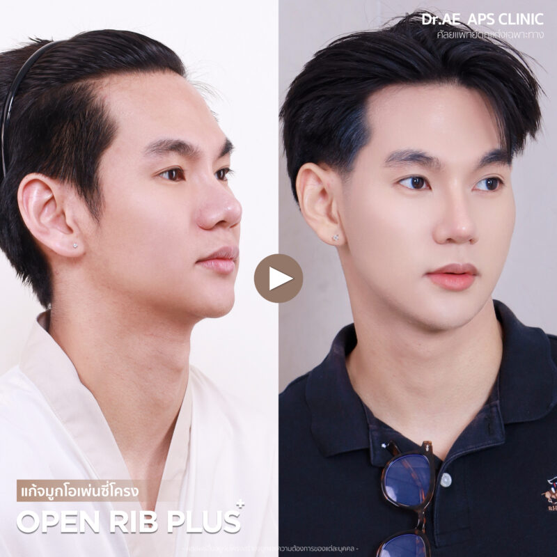 คุณโอม แก้จมูกเพิ่มความมั่นใจ