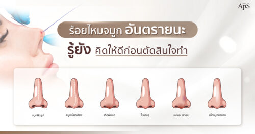 อันตรายจากการร้อยไหมจมูก