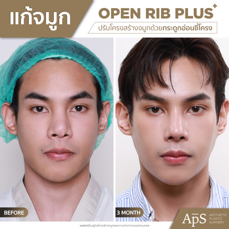 แก้จมูกคุณโจ้