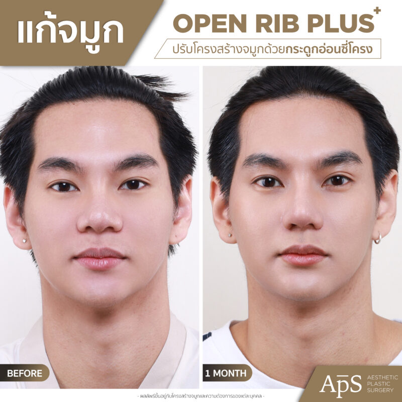 แก้จมูกคุณโอม