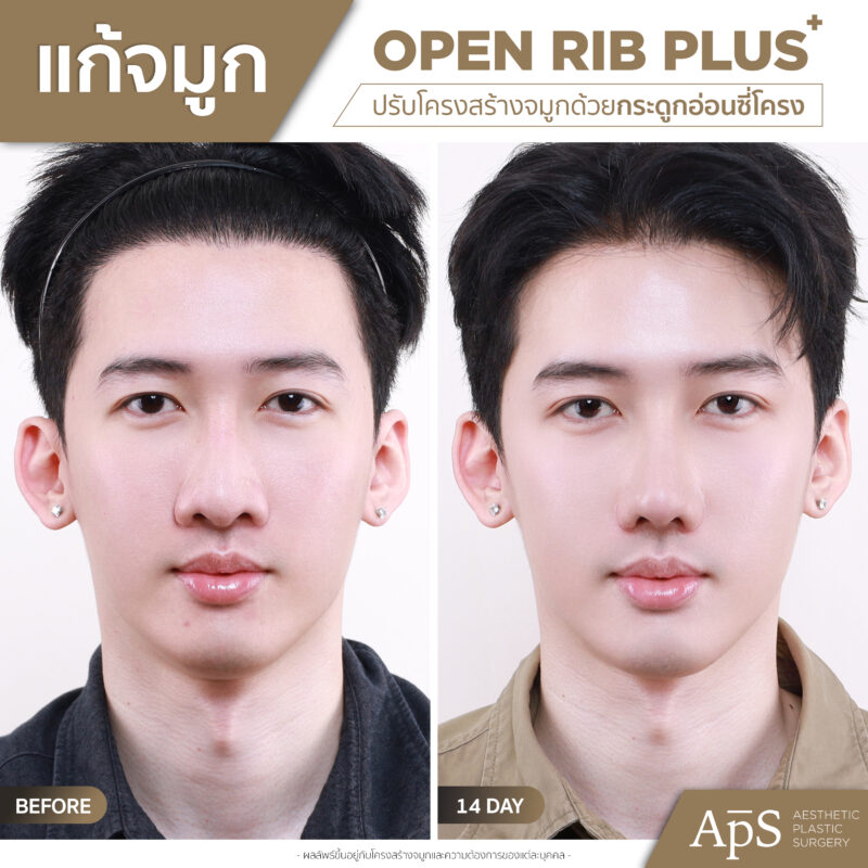 แก้จมูกคุณพีช