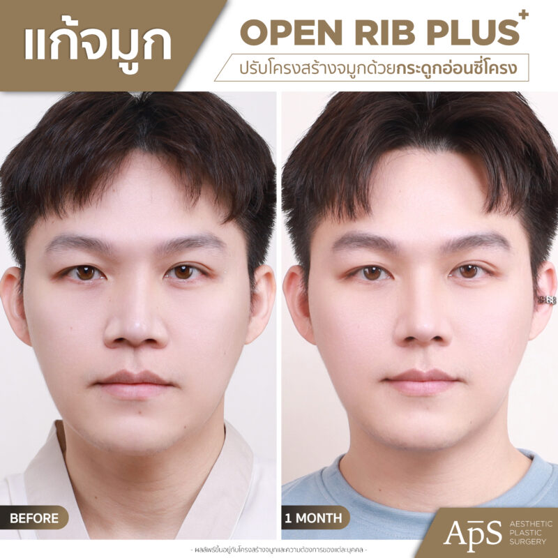 แก้จมูกคุณแบงค์