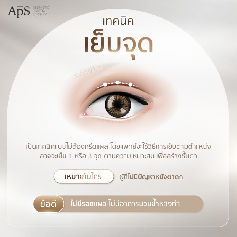 เทคนิคเย็บจุด