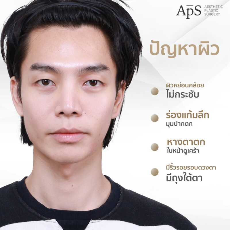 โปรแกรม Ultraformer  ยกกระชับปรับผิวเฟิร์ม ฉบับหนุ่มอินฟูล คุณนนน