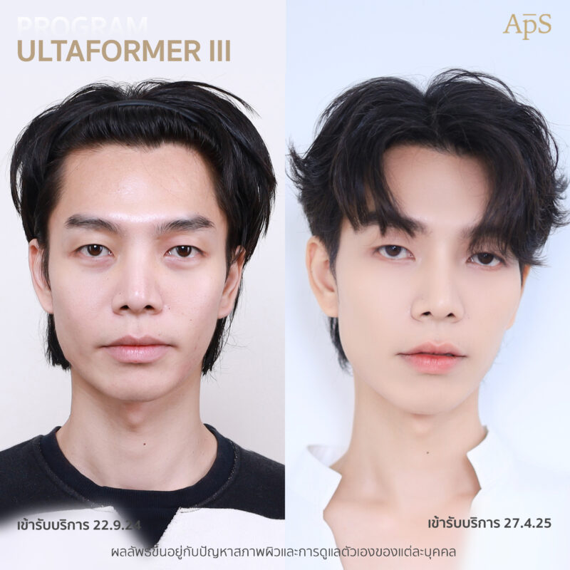 โปรแกรม Ultraformer  ยกกระชับปรับผิวเฟิร์ม ฉบับหนุ่มอินฟูล คุณนนน