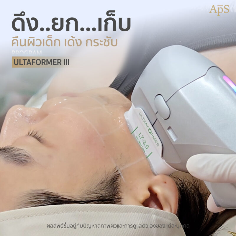โปรแกรม Ultraformer  ยกกระชับปรับผิวเฟิร์ม ฉบับหนุ่มอินฟูล คุณนนน