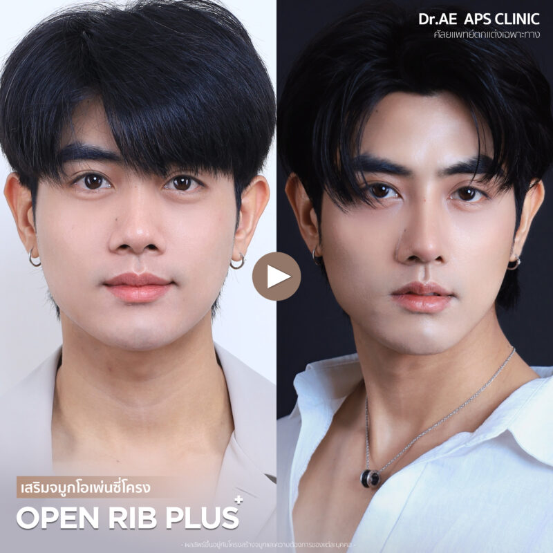 จมูกใหม่เปลี่ยนมิติให้ทั้งใบหน้าคุณพีเจ ผ่าตัดครั้งแรกในชีวิต กับผลลัพธ์ที่เกินคาด 4 จมูกใหม่เปลี่ยนมิติให้ทั้งใบหน้าคุณพีเจ