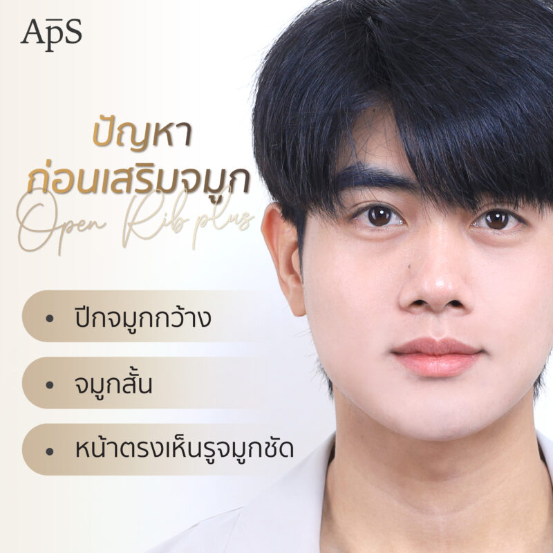 จมูกใหม่เปลี่ยนมิติให้ทั้งใบหน้าคุณพีเจ ผ่าตัดครั้งแรกในชีวิต กับผลลัพธ์ที่เกินคาด 2 ปัญหาก่อนเสริมจมูกคุณพีเจ