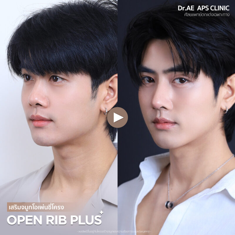 จมูกใหม่เปลี่ยนมิติให้ทั้งใบหน้าคุณพีเจ ผ่าตัดครั้งแรกในชีวิต กับผลลัพธ์ที่เกินคาด 6 ปัญหาก่อนเสริมจมูกคุณพีเจ