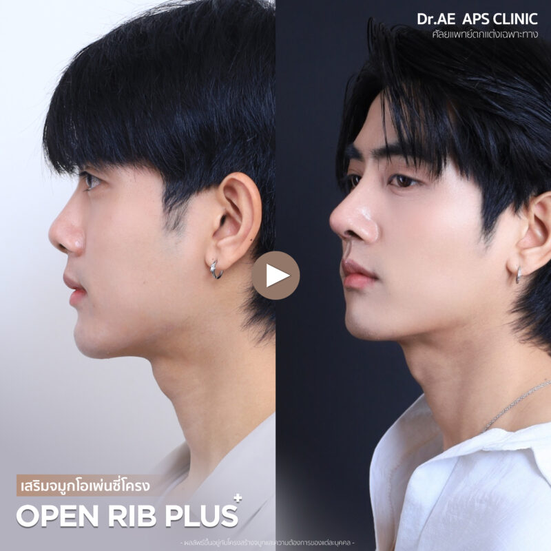 จมูกใหม่เปลี่ยนมิติให้ทั้งใบหน้าคุณพีเจ ผ่าตัดครั้งแรกในชีวิต กับผลลัพธ์ที่เกินคาด 5 ปัญหาก่อนเสริมจมูกคุณพีเจ
