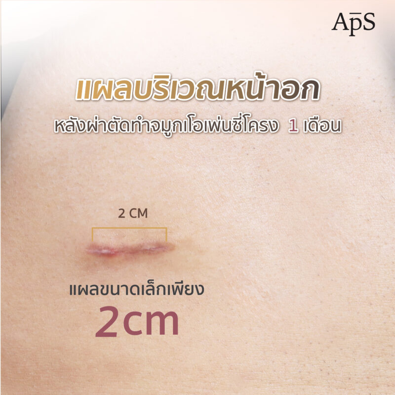 จมูกใหม่เปลี่ยนมิติให้ทั้งใบหน้าคุณพีเจ ผ่าตัดครั้งแรกในชีวิต กับผลลัพธ์ที่เกินคาด 3 แผลผ่าตัดบริเวณหน้าอก