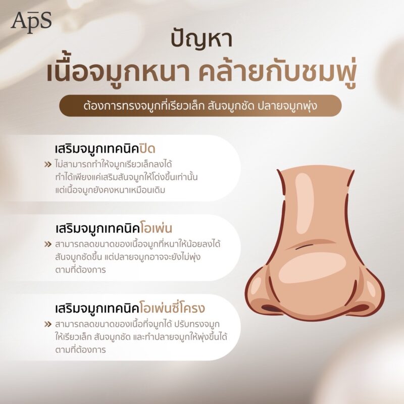 คู่มือศัลยกรรมเทคนิคเสริมจมูกที่เหมาะกับการแก้ปัญหาจมูกแต่ละแบบ 2 ปัญหาเนื้อจมูกหนาทรงจมูกชมพู่ ใช้เทคนิคเสริมจมูกใดจึงจะเหมาะสม